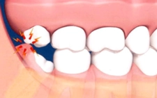 20 Lik Diş Damak Şişmesi Belirtileri ve Tedavisi