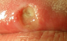 Ağız Damak Yarası Belirtileri ve Tedavisi