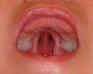 Bebeklerde Damak Düşmesi Belirtileri ve Tedavisi