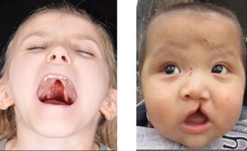 Bebeklerde Damak Yarığı Belirtileri ve Tedavisi