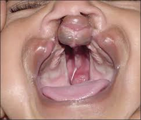 Damak Yarığı Belirtileri ve Tedavisi